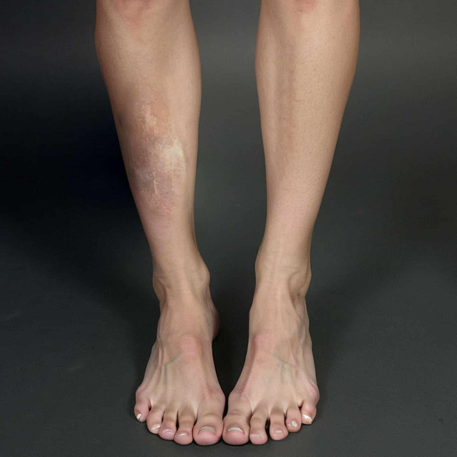 Wound healing progress after treatment at American Wound Care Center