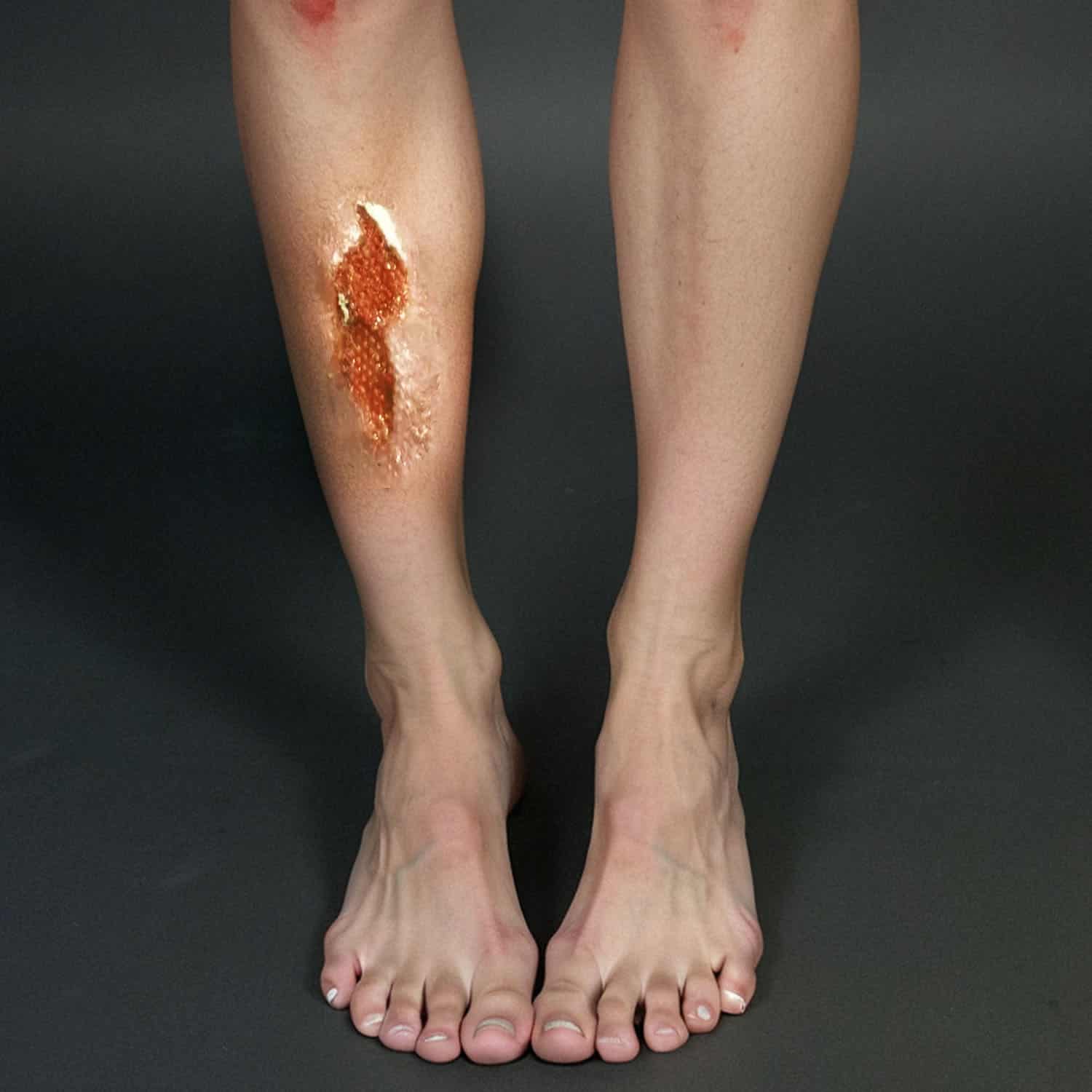 Chronic wound before treatment at American Wound Care Center