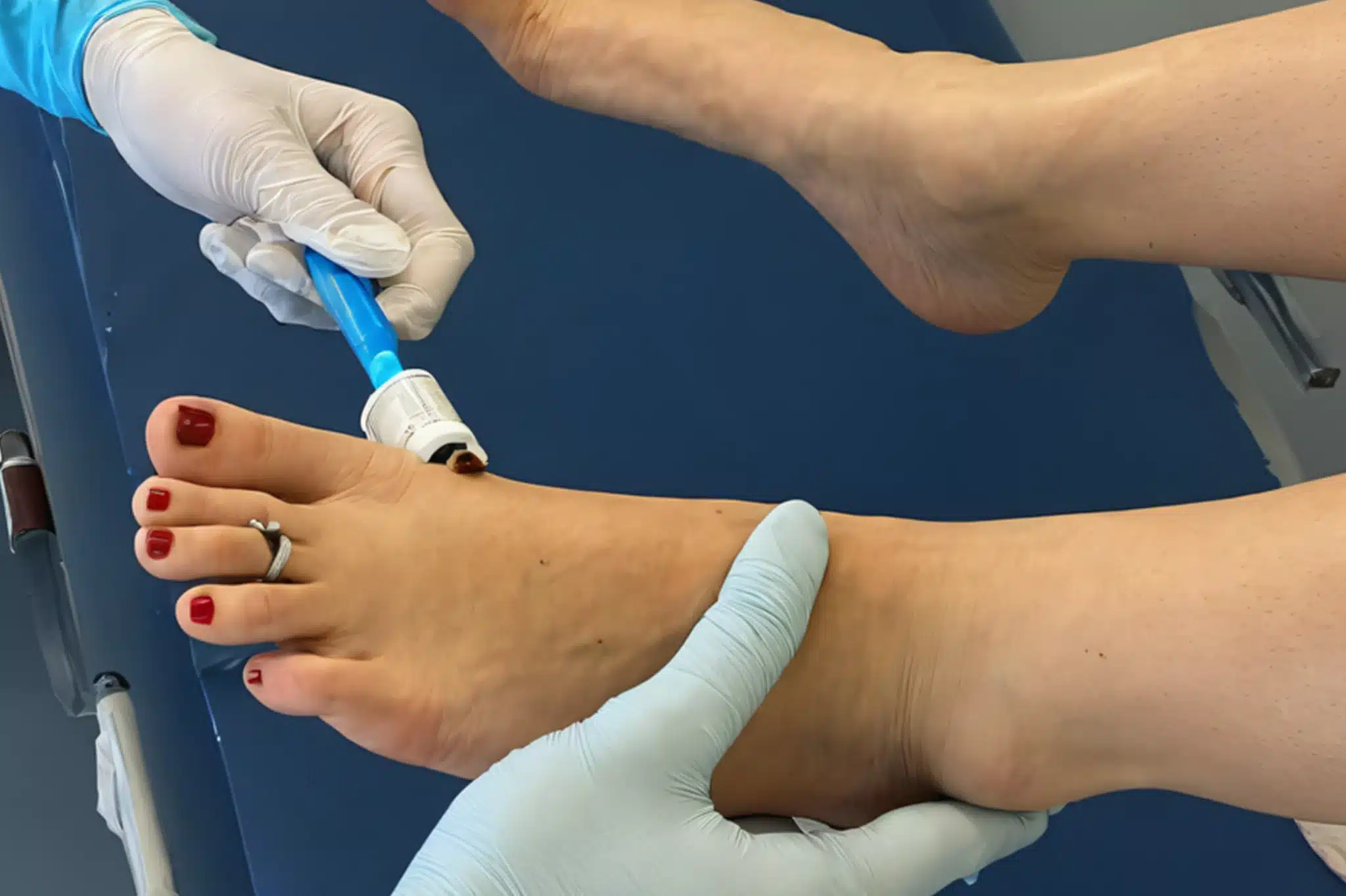 Diabetic Foot Ulcer Care at American Wound Care Center